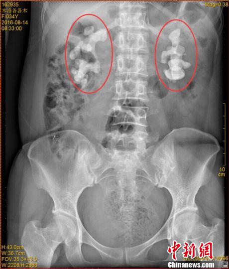 四川一女子喝生水30餘年雙腎長10釐米巨型結(jié)石